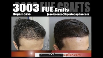 3003FUE Grafts. Repair case with scar/plugs extraction. Temporal peaks. Injertocapilar.com.2222/2018