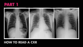 Anatomy of a Chest X-Ray - How to Read a Chest X-Ray (Part 1)