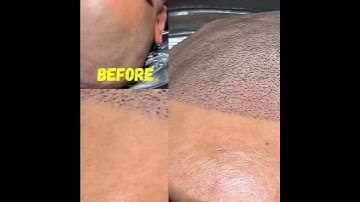 SMP scalp Micropigmentation touch up #smp