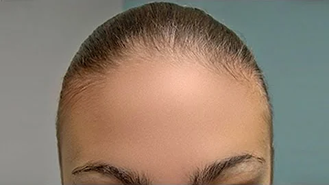 Photoshop Tutorial: How to SMOOTH SKIN and remove blemishes and scars.