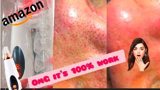 Black head remover device from Amazon | black head vacuum  work✔️ or not❌