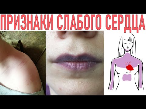 СЛАБОЕ СЕРДЦЕ ПРИЗНАКИ | 11 признаков того что у вас может случиться остановка сердца