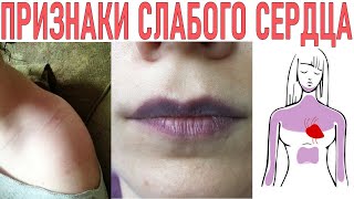 СЛАБОЕ СЕРДЦЕ ПРИЗНАКИ | 11 признаков того что у вас может случиться остановка сердца