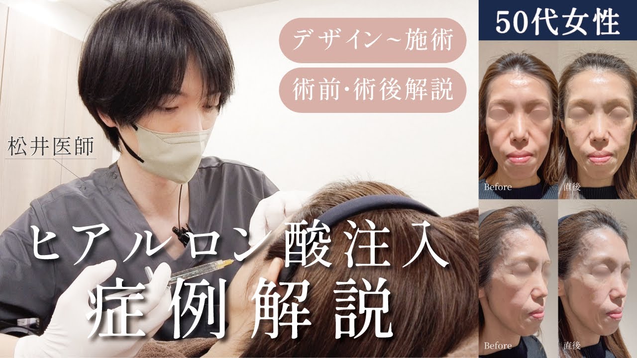 50代女性がヒアルロン酸で若々しく！【施術・症例解説】 - YouTube