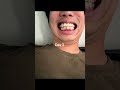 day15  #braces#invisalign