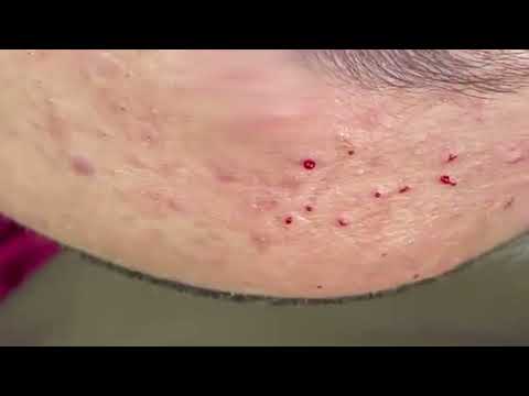 #blackhead  #whitehead #acne #blackheads #pimple #blackheadremoval  #blackheadextraction #skincare