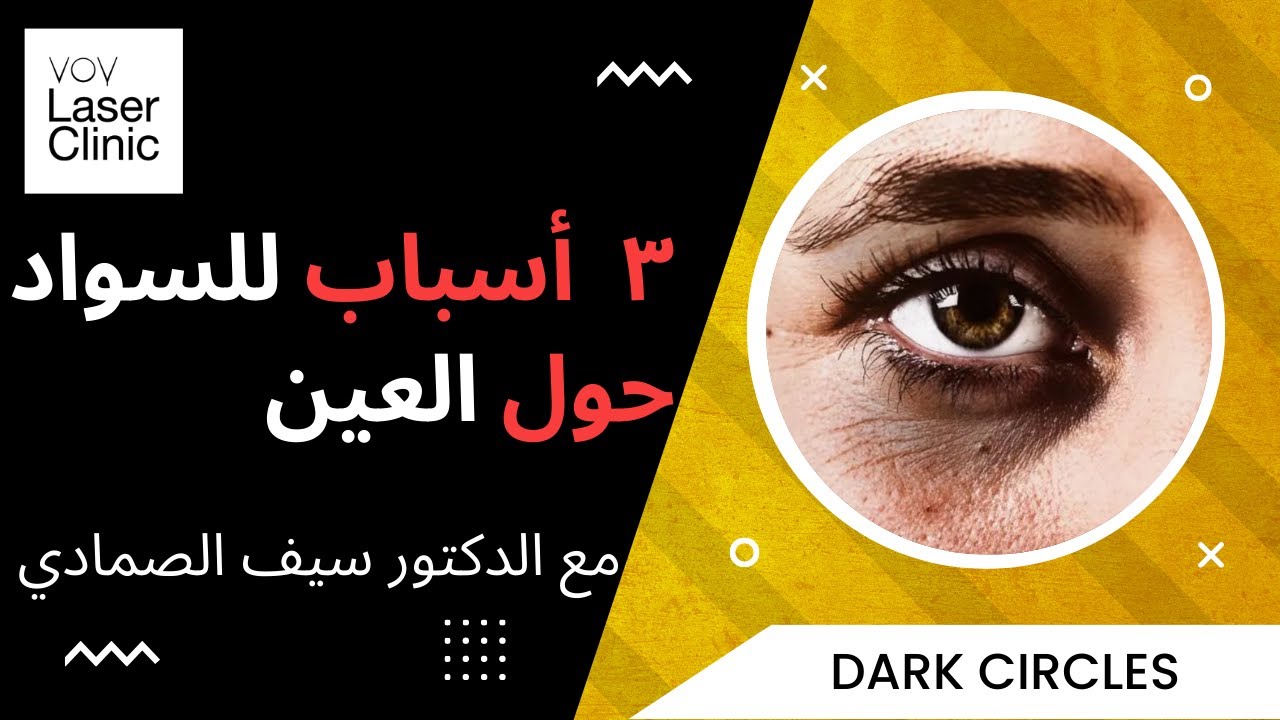 ٣ أسباب للسواد حول العيون مع طرق علاج كل سبب