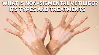 What is non segmental vitiligo? Vitiligo symptoms and treatments