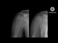 Simple Bone Cyst
