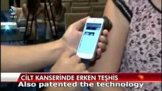 Smartphone Teledermoscopy - The first mobile multiscpectral dermatoscope