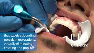 Ultra Bond Plus® 30 Second Dentistry™ Patient Kaveh Ultra Bond Plus® 30 Second Dentistry™ Patient Kaveh