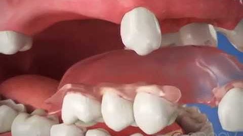Partial Denture