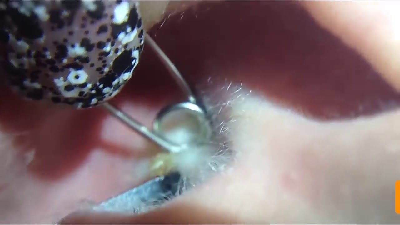 Ear Cyst Explosion Popping Youtube