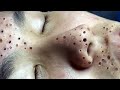 Relax Skincare Everyday with Acne Blackheads Treatment Spa #98081