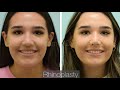 Dallas Rhinoplasty Before and After