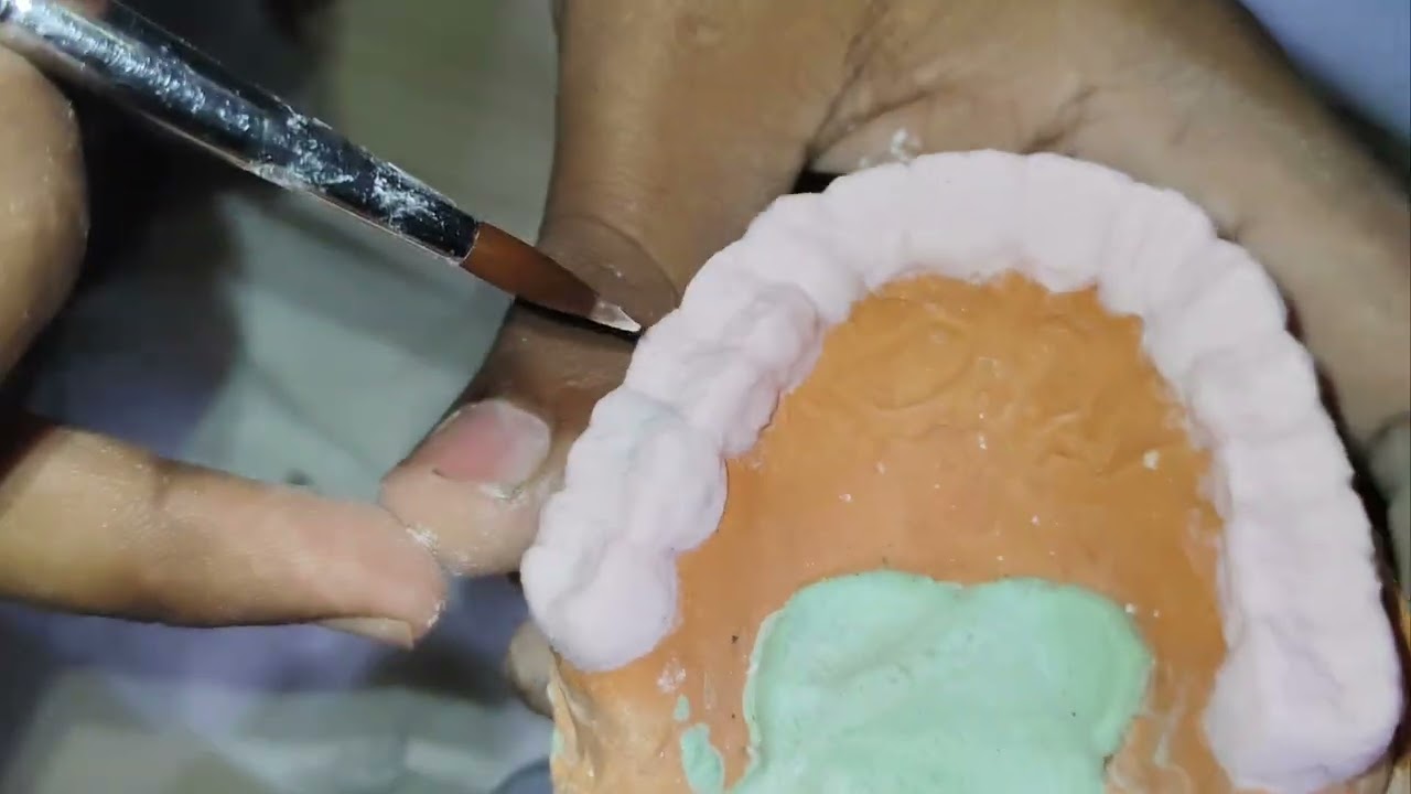 ceramic buildup