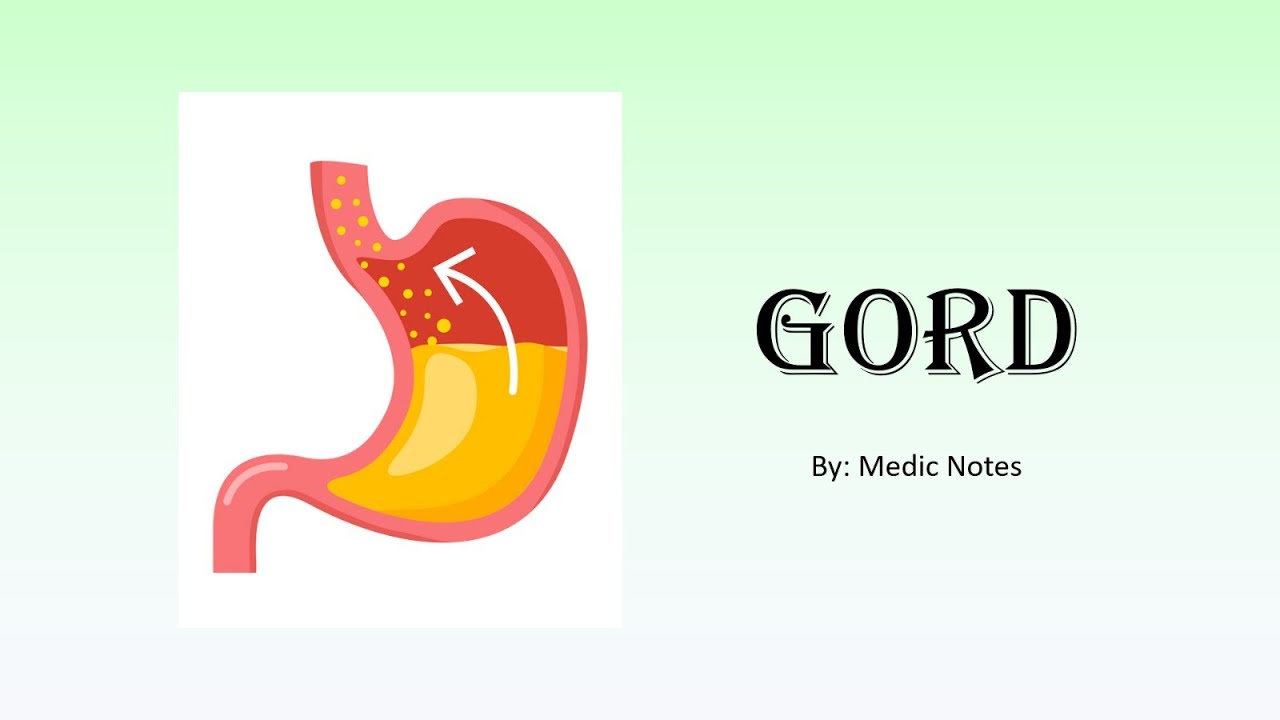 GORD - Gastroesophageal reflux disease, etiology, investigations, treatment, surgeries