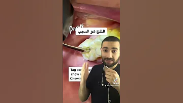 عادة تكسر الاسنان وتؤدي لفقد الأسنان لا تفعلها 