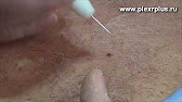 ангиома вишневая фото смотреть