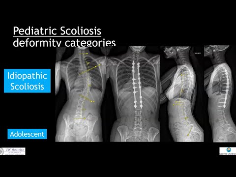 Non-AIS Scoliosis: What's