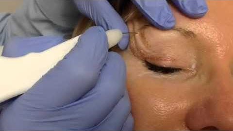Watch As Dr. Dev Patel Walks You Through a Plexr Blepharoplasty Treatment