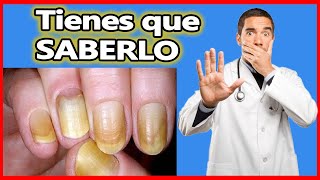 Como Blanquear Las Uñas Amarillas De Las Manos Y Pies