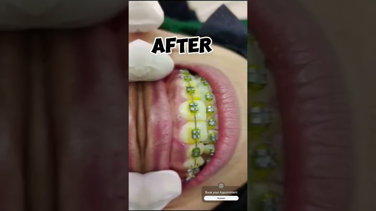 Best Orthodontist in Multan | Braces | Expert in Braces | Orthodontist in Multan | 