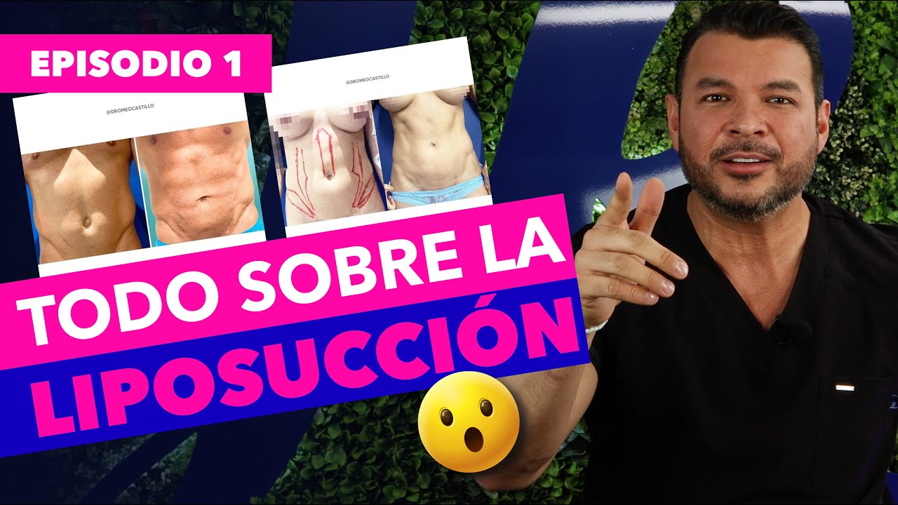 Todo sobre la LIPOSUCCIÓN | Dr. Romeo Castillo CIRUJANO | PODCAST EP. 1