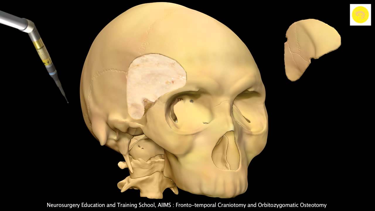 Neurosurgery 3D Animation Video : Frontotemporal Orbitozygomatic-FTOZ Approach - YouTube