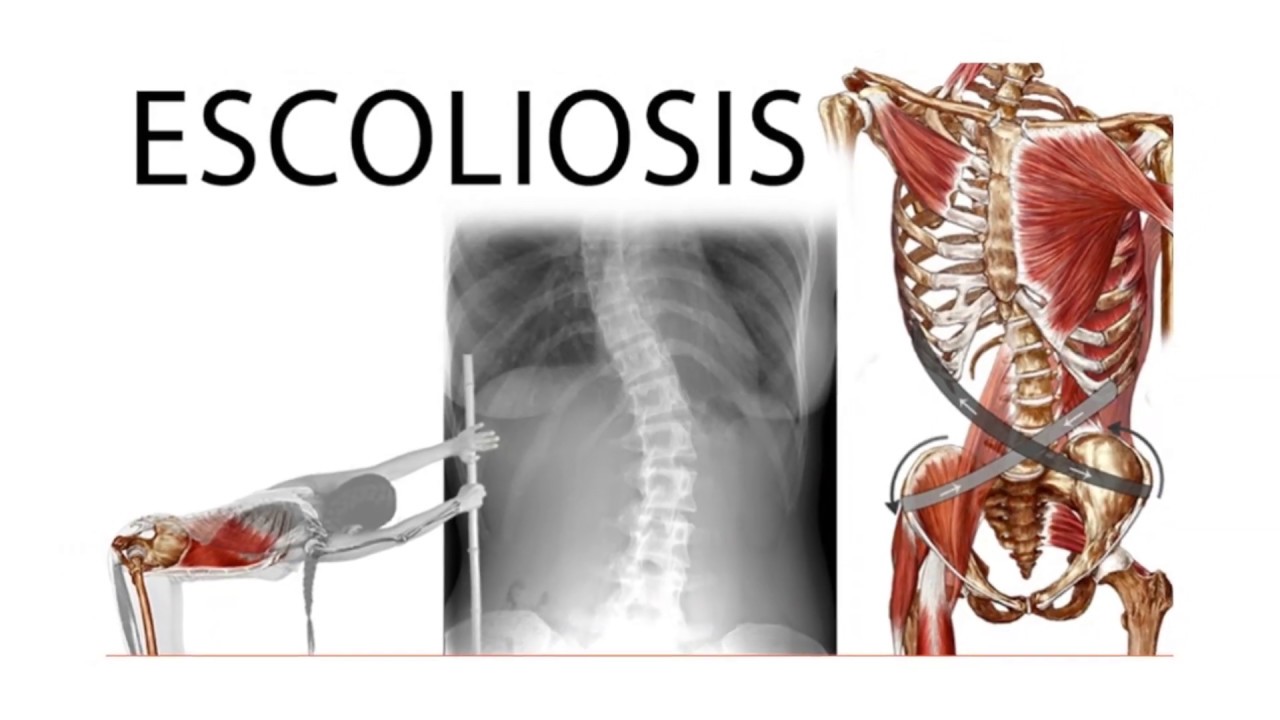 Escoliosis Estructurada Y No Estructurada CURSO DEFINITIVO PARA LA ESCOLIOSIS EN LÍNEA - YouTube
