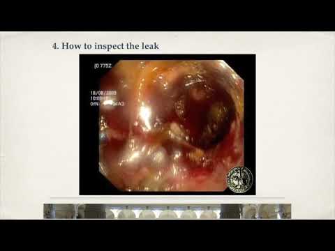 ENDOSPONGE tips and tricks highlights