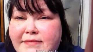 Lupus 1-25-11 a day in life with lupus vlog