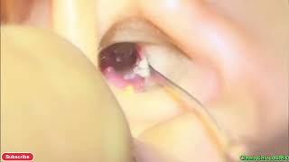 The Biggest Ear Wax Chunk We&#39;ve Ever Removed! 😳📦
