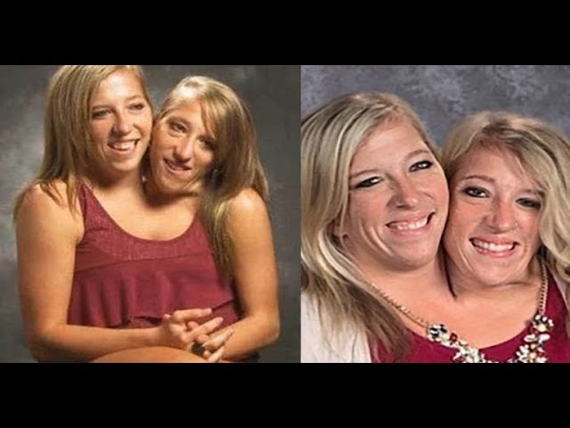 Abigail & Brittany Hensel - The Twins Who Share a Body - video Dailymotion