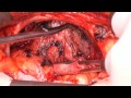 nns Radical Retropubic Prostatectomy