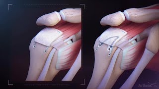 CuffMend™ Rotator Cuff Repair Augmentation System