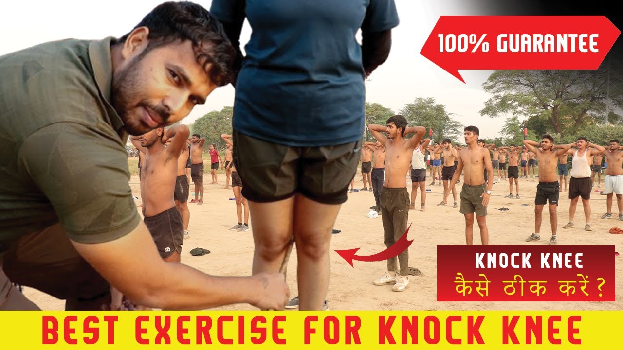 Knock Knee Kaise thik kare ?| Knock knee Solution | knock knee best exercise | knock knee treatment