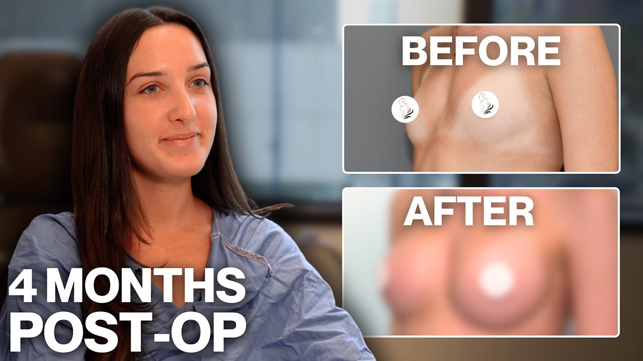 4 Months After Breast Augmentation: Petite Frame, Natural Results!