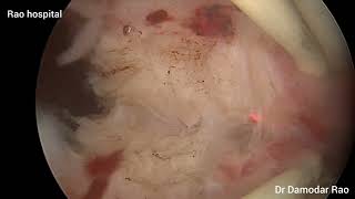 Hysteroscopic resection of Complete Uterine Septum using scissors and Bipolar Resectoscope