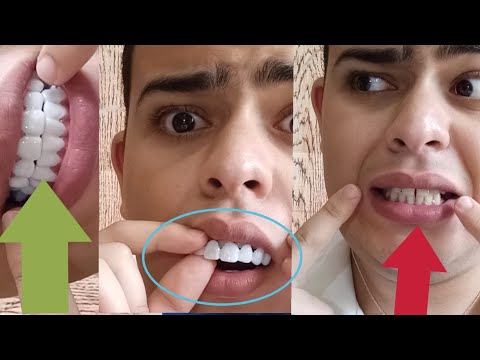تجربة تركيب أسنان المشاهير بأرخص ثمن