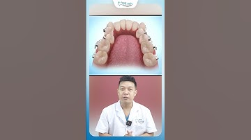 Những Điều Bạn Sẽ Phải Trải Qua Khi Niềng Răng | Nha Khoa Minh Châu