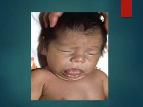 Vidéo: Hypothyroïdie Chez Les Enfants - Hypothyroïdie Congénitale Et Subclinique Chez Les Enfants