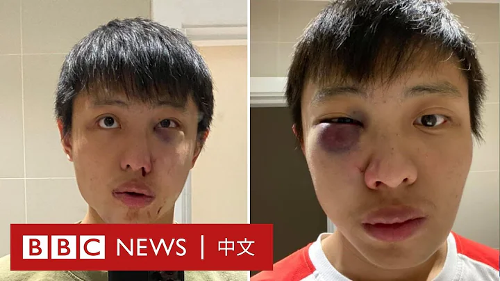 新冠肺炎：亚裔留学生受歧视 伦敦街头被殴打－ BBC News 中文 - 天天要闻