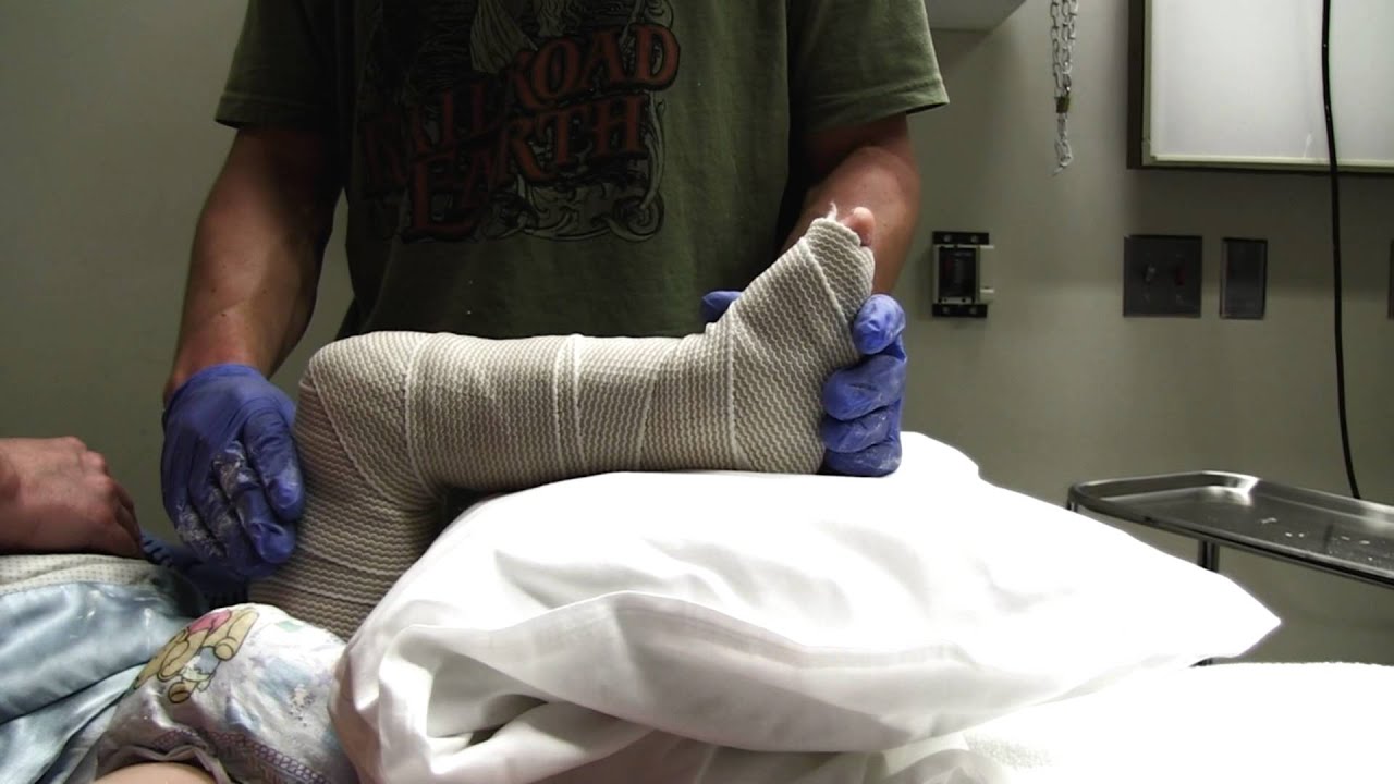 Childhood Accidental Spiral Tibial Fracture - YouTube