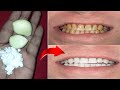 DIY TEETH WHITENING IN 2 MINUTES (100% Works) | How To Whiten Teeth At Home for Cheap &amp; Naturally