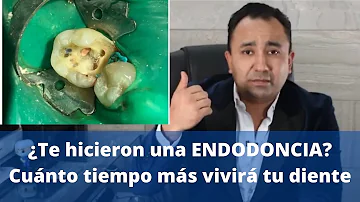 ¿Cuánto dura una endodoncia en un molar?