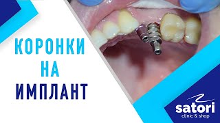 Имплантация зубов: коронки на импланты, снятие оттиска, фиксация коронок
