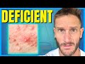 The #1 Cause of Acne in Adults (how to stop it)