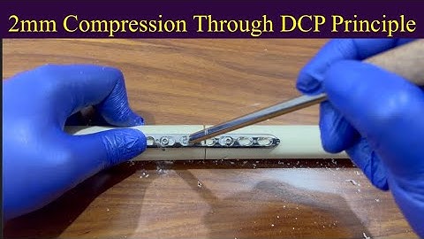 2mm Compression with Dynamic Compression Plating (DCP) principle