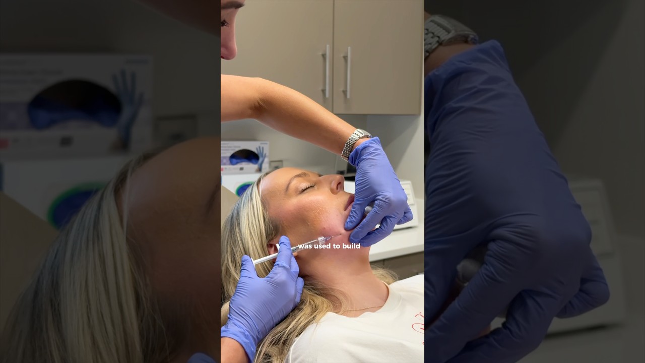 Let’s talk chin filler 💉